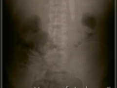 X-ray of Andrew S. sword swallowing / FRONT